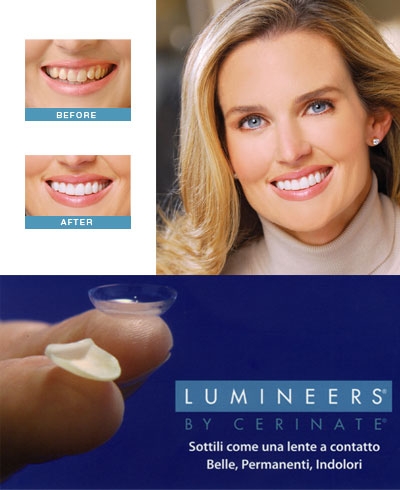 Faccette Ceramica Lumineeers